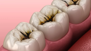 Illustration de molaires endommagées par des caries