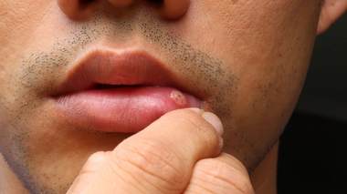 Certains aphtes peuvent être causés par des maladies (photo d'illustration)