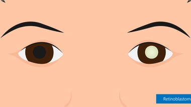 Un dessin de rétinoblastome