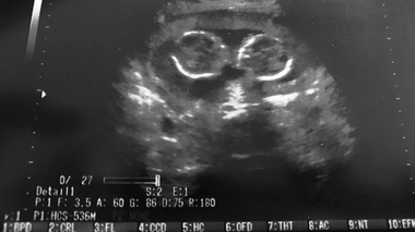 Une échographie de bébé siamois (photo d'illustration)