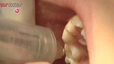 Le mercure dentaire est-il dangereux pour la santé ?