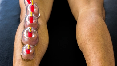 La hijama est très appréciée par les sportifs de haut niveau (photo d'illustration)