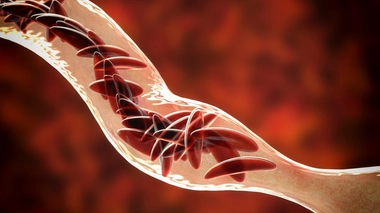 La drépanocytose peut boucher les vaisseaux sanguins (photo d'illustration)