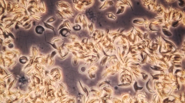 Une drépanocystose ou anémie falciforme dûe à une mutation de l'hémoglobine