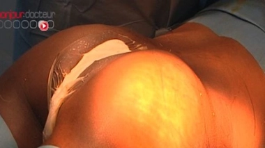 Avoir de belles fesses : quelle chirurgie ?