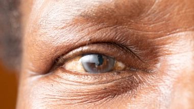 La cataracte est l'une des principales causes de cécité au Cameroun (Illustration)