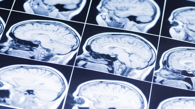 L'accident vasculaire cérébral est une perte soudaine de la fonction du cerveau (Illustration)