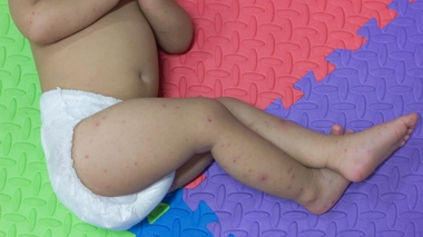 Certains enfants qui ont contracté la varicelle n’ont que quelques cloques