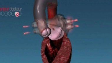 Valves cardiaques : l'innovation sécurisée