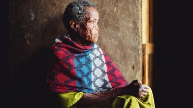 Une personne affectée par la lèpre à Addis Abeba, en Ethiopie