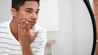 L'acné touche essentiellement les adolescents 