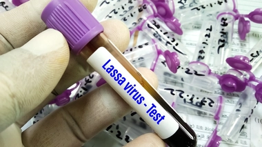 La fièvre de Lassa réapparait au Royaume-Uni 