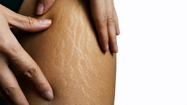 Pourquoi les vergetures s'aggravent avec la grossesse ?
