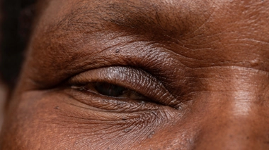 Il y a différentes formes de ptosis