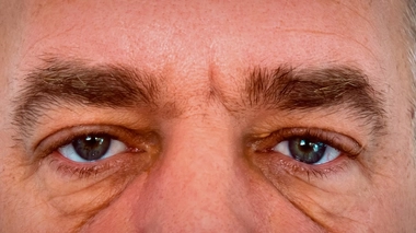 Les poches sous les yeux peuvent apparaître avec l'âge