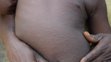 Un jeune enfant atteint de rougeole 