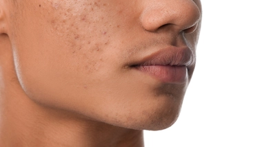 De nombreux adolescents ont des boutons 