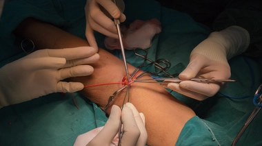 Création d'une fistule artério-veineuse 