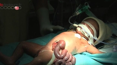 Laparoschisis : naître avec l'abdomen ouvert