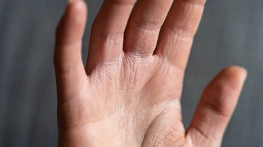 L'eczéma des mains est très fréquent