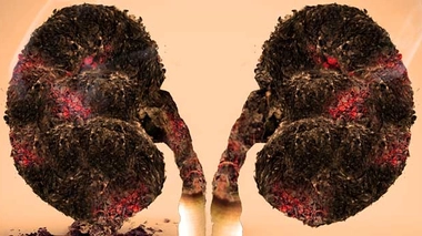 Le tabagisme est la première cause du cancer du poumon 