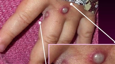 La variole du singe a été identifiée au Maroc