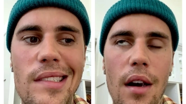 Justin Bieber souffre d'une paralysie au visage