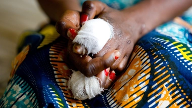 Une Congolaise atteinte par la lèpre