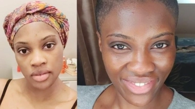 Une femme s'étant dépigmentée la peau (photo d'illustration)