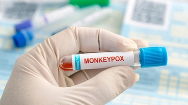 Un Italien testé positif au Covid, au VIH et à la variole du singe en même temps