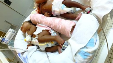 Les bébés siamois ont été séparés avec succès, le 6 octobre dernier
