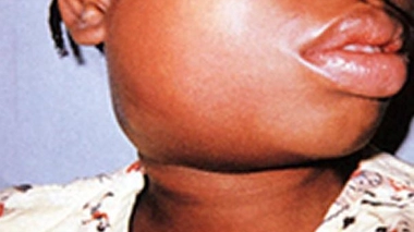 Les oreillons se transmettent facilement d'une personne à l'autre