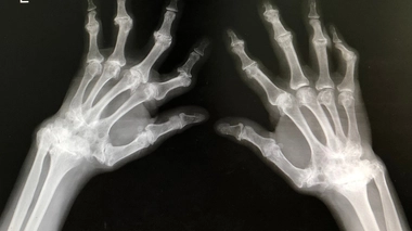 La polyarthrite rhumatoïde est le plus fréquent des rhumatismes inflammatoires