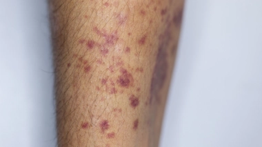 L'apparence physique du bras d'un hémophile