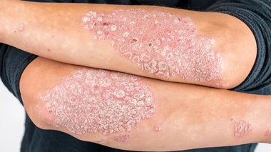 Le psoriasis touche de nombreuses personnes en Afrique