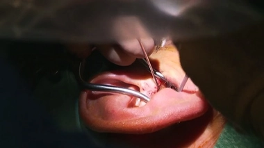 Surdité précoce : et si c'était l'otospongiose ?