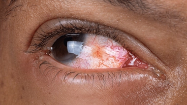 Lorsqu'elle est infectieuse, la conjonctivite est très contagieuse