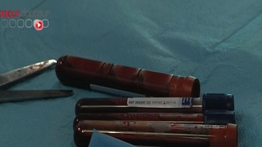 Parkinson : vers un meilleur diagnostic ?