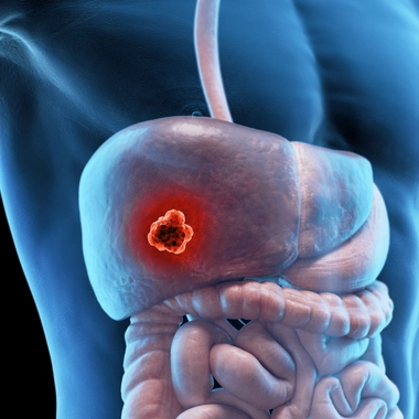 Dépister et prévenir le cancer du foie
