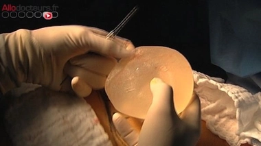 Prothèses PIP : un quatrième cas signalé