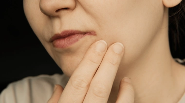 Tout savoir sur la perlèche 