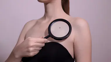 surveiller ses grains de beauté