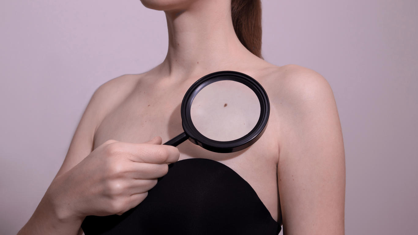 Quand faut-il consulter un dermatologue pour ses grains de beauté ?