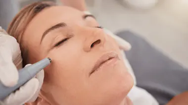 micro-needling