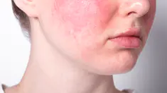 Comment se débarrasser des rougeurs sur la peau ?