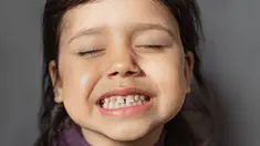 pourquoi les enfants ont parfois des taches noires sur les dents ? 