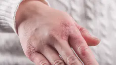 prévenir et soigner les engelures : toutes nos astuces !