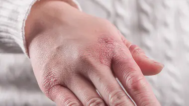 prévenir et soigner les engelures : toutes nos astuces !