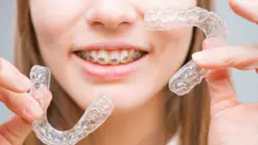 Orthodontie adulte : bagues ou aligneurs ?