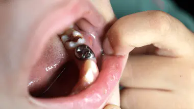 Vos vieux plombages dentaires sont-ils sûrs ? 